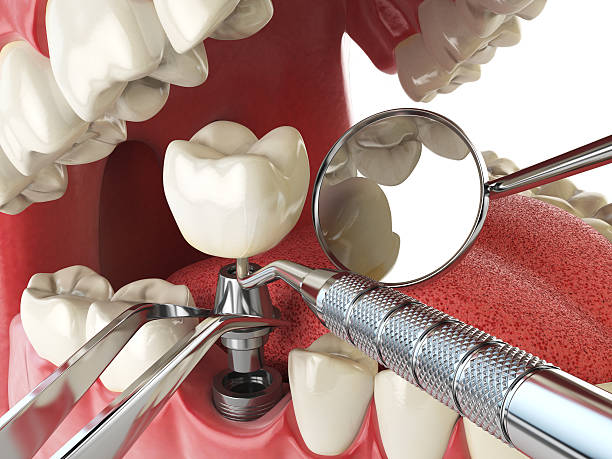 Best Emergency Tooth Extraction in Dawson, GA